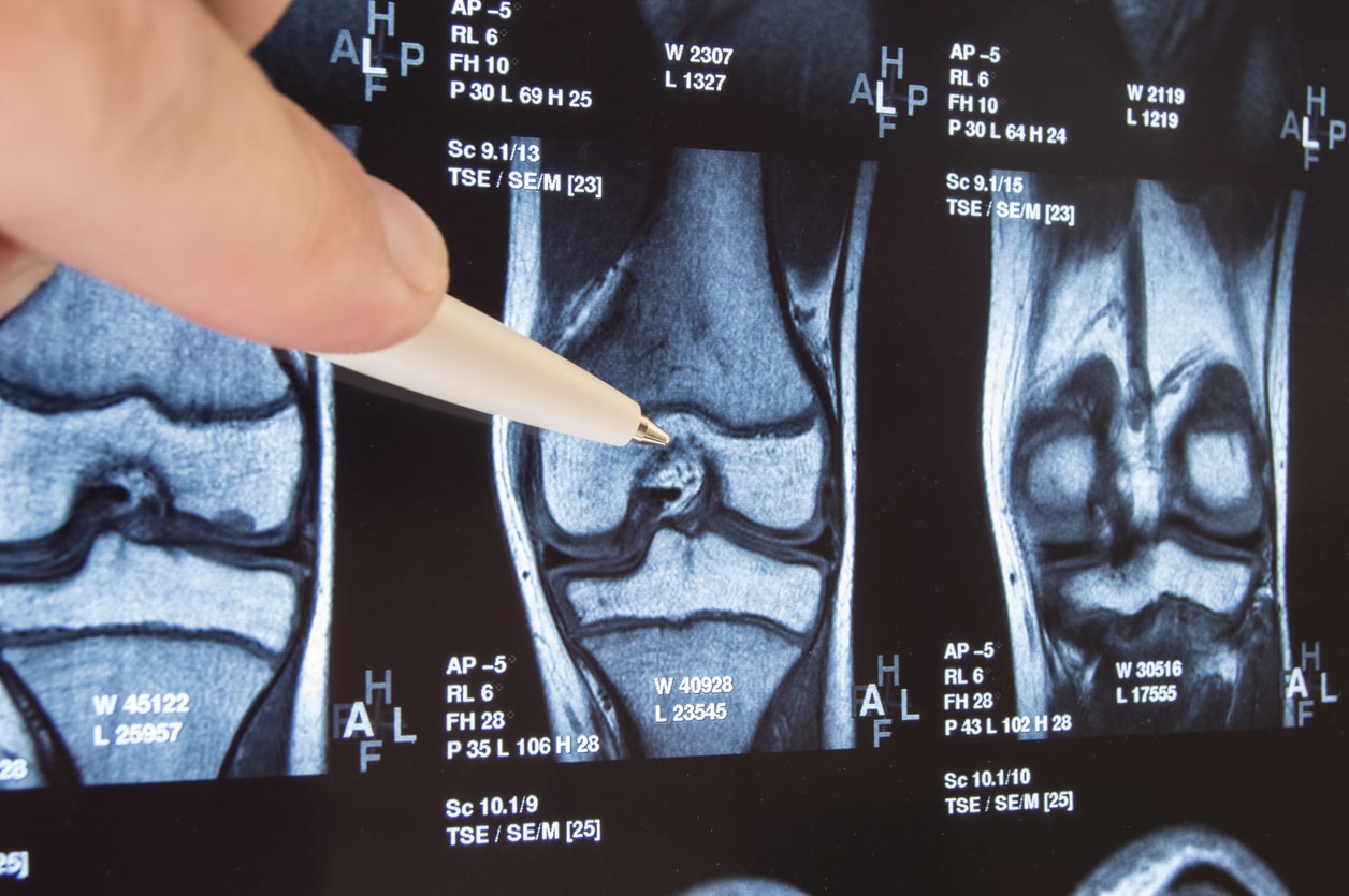 Orthopedics & Traumatology in Türkiye with Turquaz Health